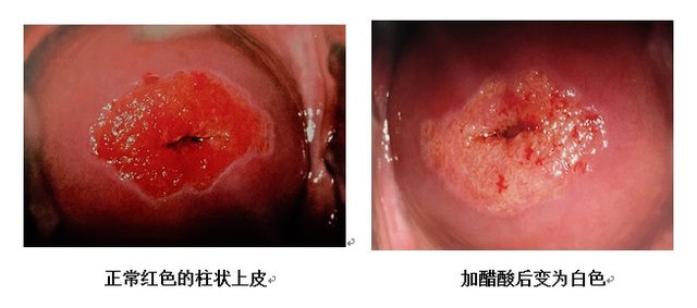 淺談電子陰道鏡作用以及碘反應